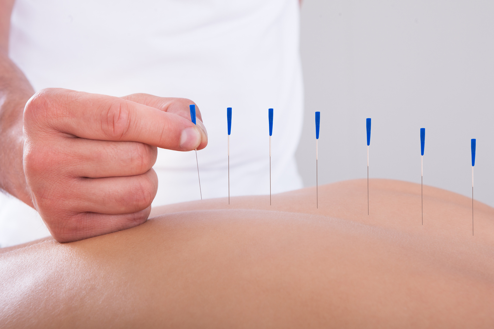 woman-receiving-an-acupuncture-therapy